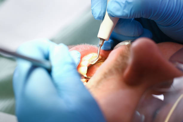 Best Emergency Root Canal Treatment in North Branch, MN